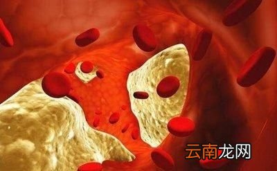 甘油三酯到底是什么呢
