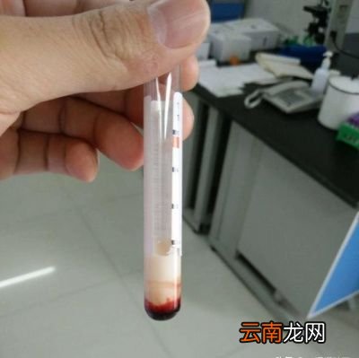 甘油三酯增高应该如何治疗