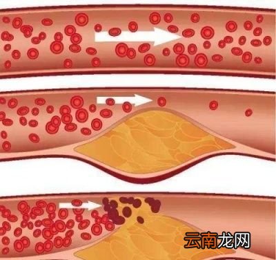 甘油三酯增高应该如何治疗