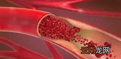 怎么才能降低甘油三酯水平呢