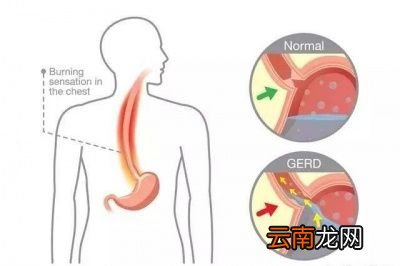 减肥的时候为什么会出现饥饿感