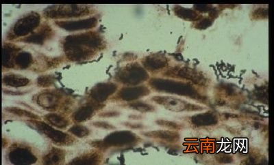 用过的碗筷会传播幽门螺旋杆菌吗