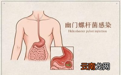 幽门螺旋杆菌的传染途径有哪些