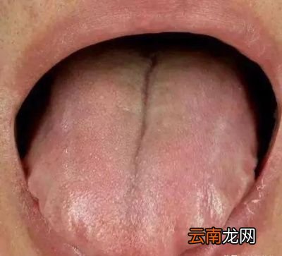 梅雨季节容易染湿气吃什么能够除湿健脾