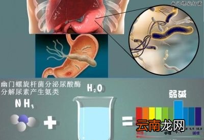 幽门螺旋菌感染的患者如何治疗呢