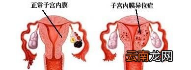 什么是子宫内膜异位症