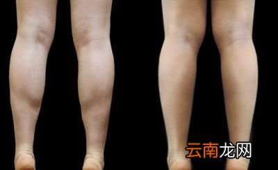 脂肪型粗腿丨瘦腿方法