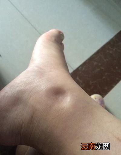 脂肪型粗腿丨瘦腿方法