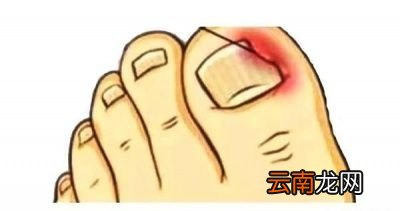 趾 指甲长进肉里引起红肿流脓是什么情况