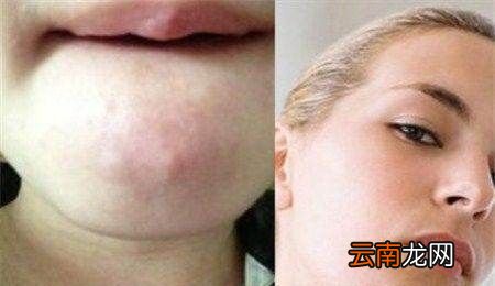 下巴的硬疙瘩是怎么消