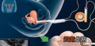 刚怀孕一个月的孕妇能做阴超吗