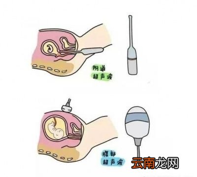 刚怀孕一个月的孕妇能做阴超吗