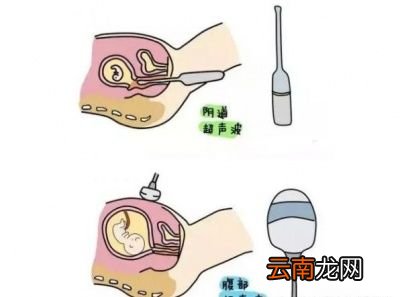 刚怀孕的准妈妈能做阴超吗