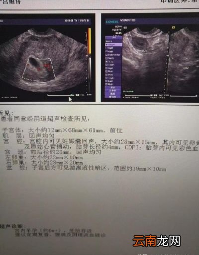 孕早期可以做阴试彩超吗