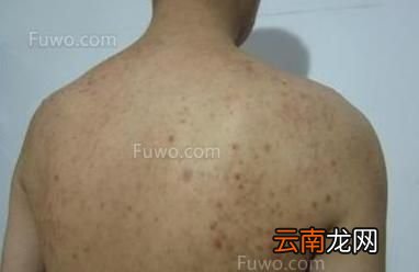 男性湿气重应该怎么排除湿气