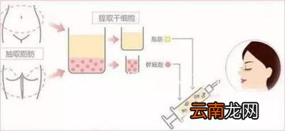 任学会面部脂肪填充怎么样？脂肪填充的原则是哪些？