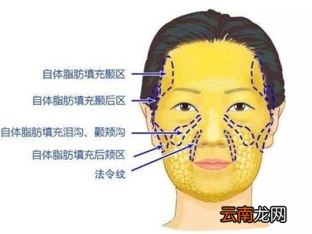 任学会面部脂肪填充怎么样？脂肪填充的原则是哪些？
