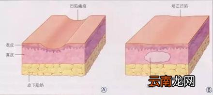 任学会面部脂肪填充怎么样？脂肪填充的原则是哪些？