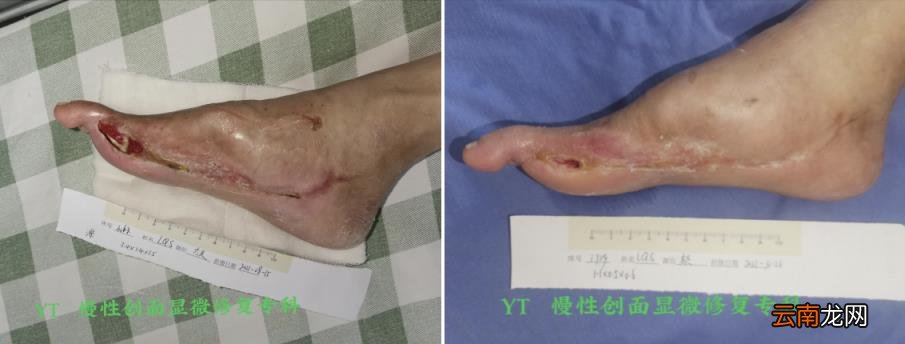 中山源田骨科医院手术效果好吗？慢创快治－－糖足的微创治疗