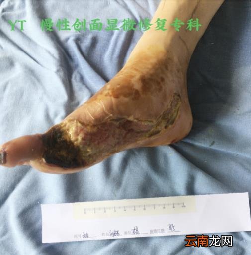 中山源田骨科医院手术效果好吗？慢创快治－－糖足的微创治疗