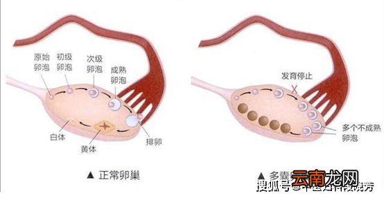 多囊卵巢综合症怎么调理才能好起来