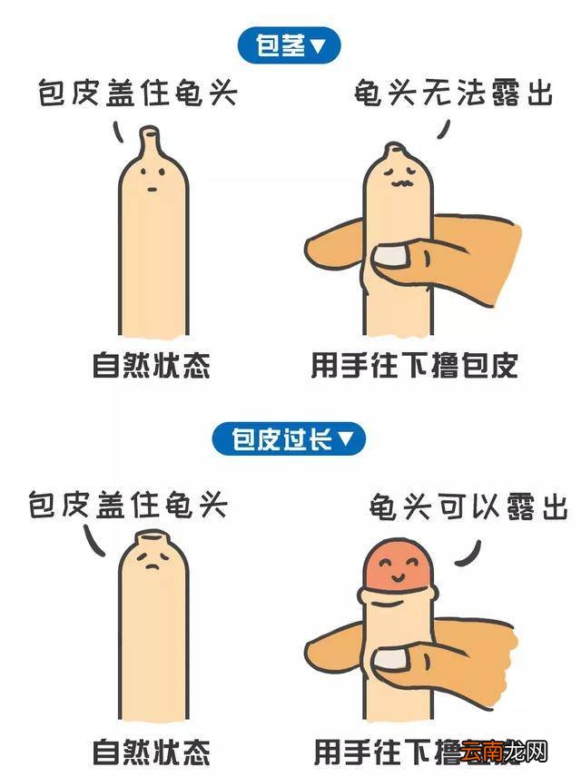小孩子做包茎手术几岁合适