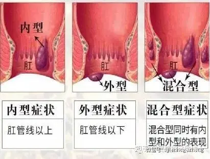 怎么判断自己得了痔疮