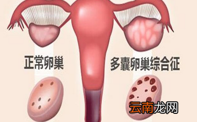 多囊卵巢综合症