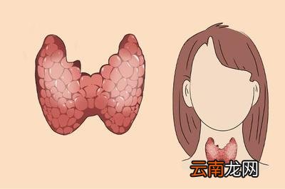 甲状腺结节会自愈吗