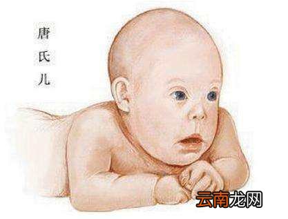 唐氏综合症是啥病