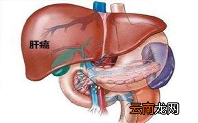 肝癌晚期能活多久一般