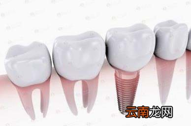 种牙怎么就成了医疗美容