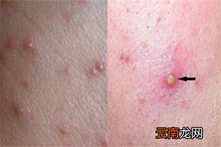 毛囊炎最佳治疗方法