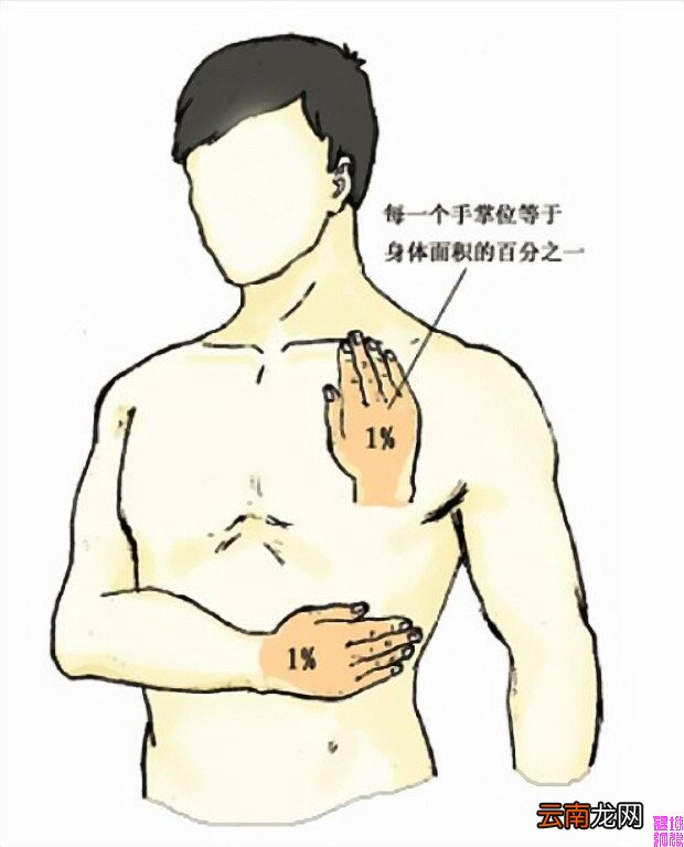 烧伤面积口诀三三三五六七
