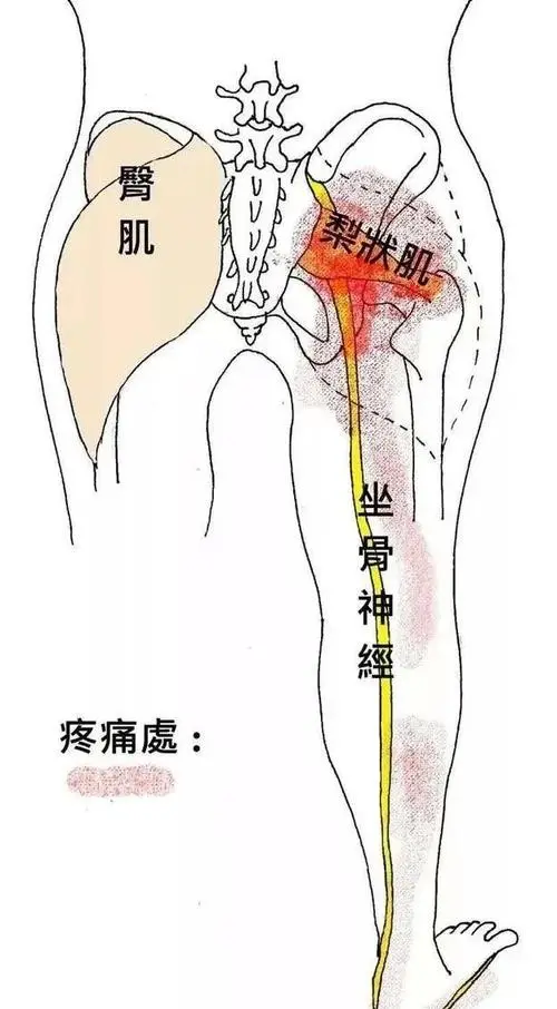 坐骨神经痛是指哪个地方疼