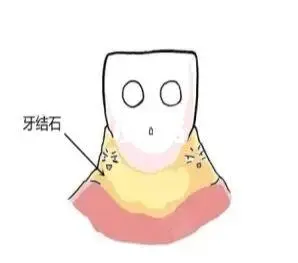 牙结石怎么处理
