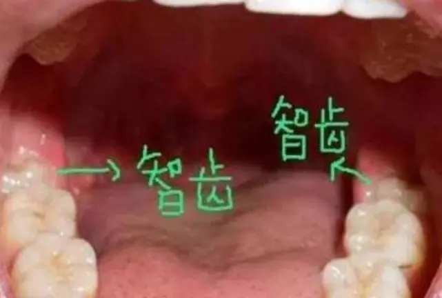 怎样辨别长没长智齿