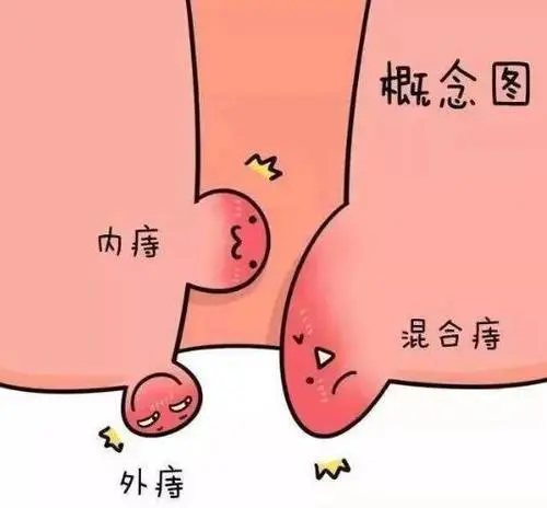 肛门肉球会自己消失吗