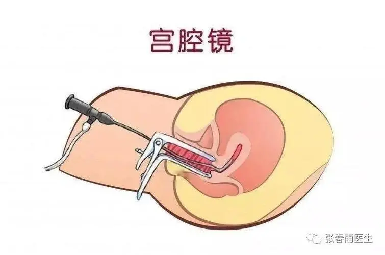 宫腔镜检查怎么做