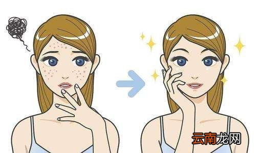 祛痘常识