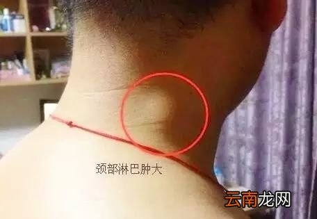 淋巴结肿大怎么消除 颈部