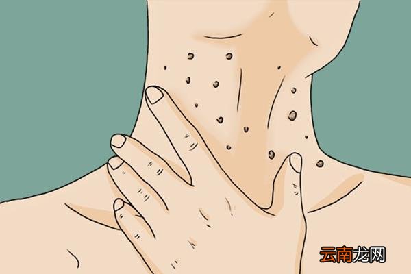 脖子上长了小肉粒怎么回事