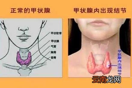 甲状腺结节怎么治疗最好的方法