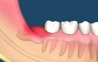 牙龈肿痛怎么办?