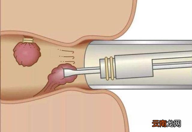 肛门口有个肉球突出是怎么回事