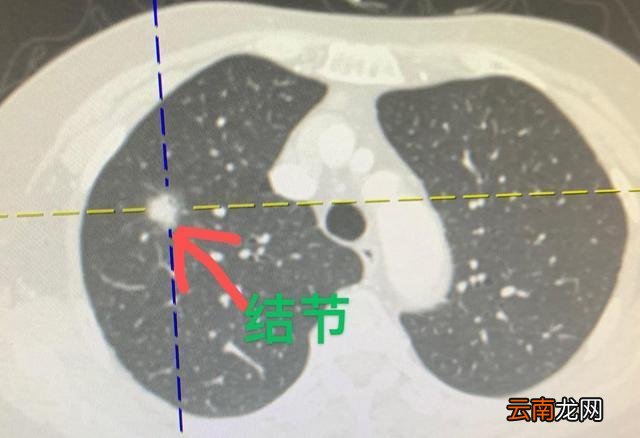 肺部有结节是怎么回事?要紧吗?