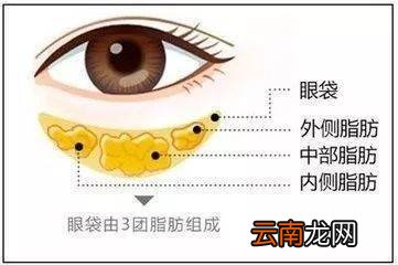 消除眼袋的最好方法 眼袋最快消除