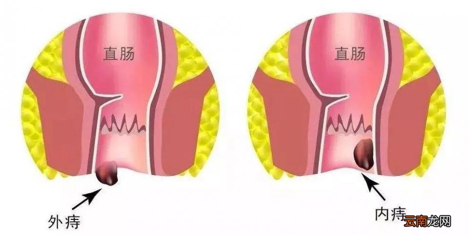 痔疮外痔肉球怎么消除