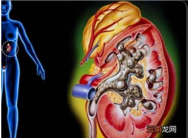肾结石怎么才能快速排出来