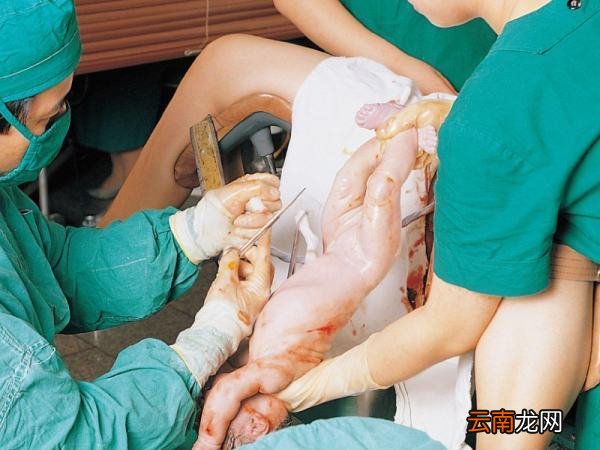 脐带的剪断真的可以“晚剪”吗